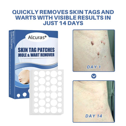 Alcuras® Moles & Warts Removing Skin Tag Patch