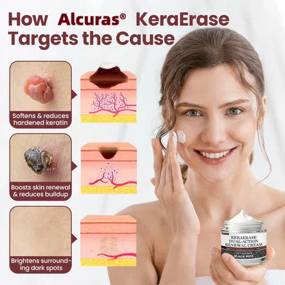 💥Alcuras® KeraErase Dual-Action Renewal Cream