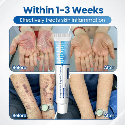 💥Alcuras® Fragile Skin Repair Cream🛡️ Multi-Repair for Bruises, Dryness & Spots