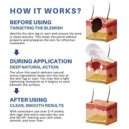 Alcuras® Moles & Warts Removing Skin Tag Patch