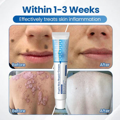 💥Alcuras® Fragile Skin Repair Cream🛡️ Multi-Repair for Bruises, Dryness & Spots