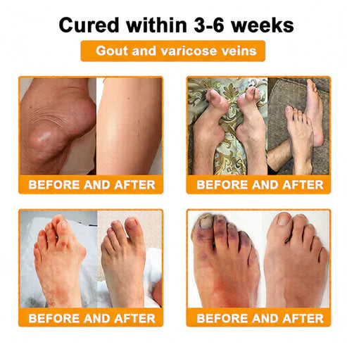 🏆50K+ SOLD LAST WEEK! 🌿Alcuras® Bee Poison Pain-Relief Bone Healing Cream