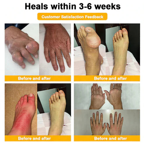🏆50K+ SOLD LAST WEEK! 🌿Alcuras® Bee Poison Pain-Relief Bone Healing Cream