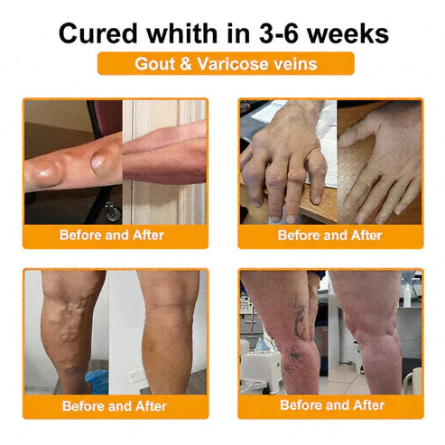 🏆50K+ SOLD LAST WEEK! 🌿Alcuras® Bee Poison Pain-Relief Bone Healing Cream