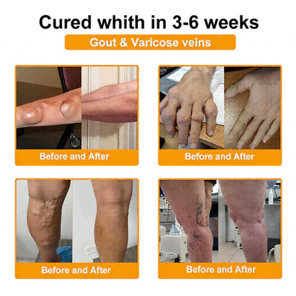 🏆50K+ SOLD LAST WEEK! 🌿Alcuras® Bee Poison Pain-Relief Bone Healing Cream