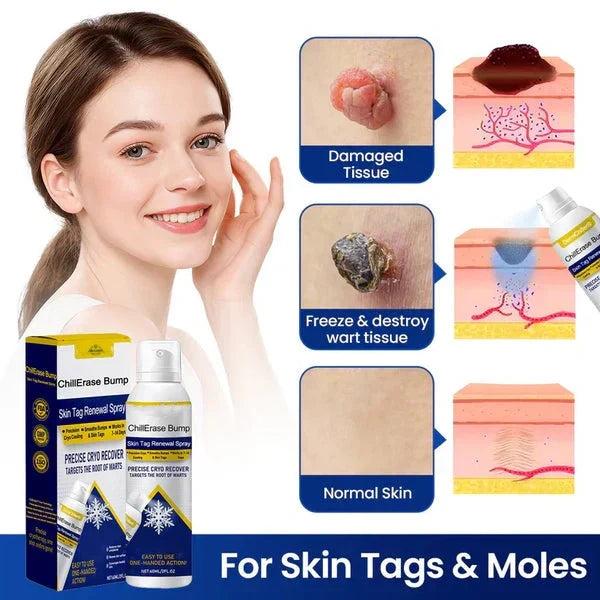 💥Alcuras® ChillErase Bump & Skin Tag Renewal Spray