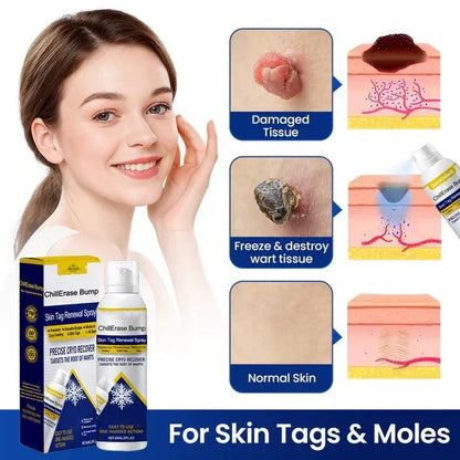 💥Alcuras® ChillErase Bump & Skin Tag Renewal Spray