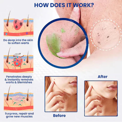 ✅ Official Store: Alcuras® NatureErase Instant Mole & Spot Removal Gel
